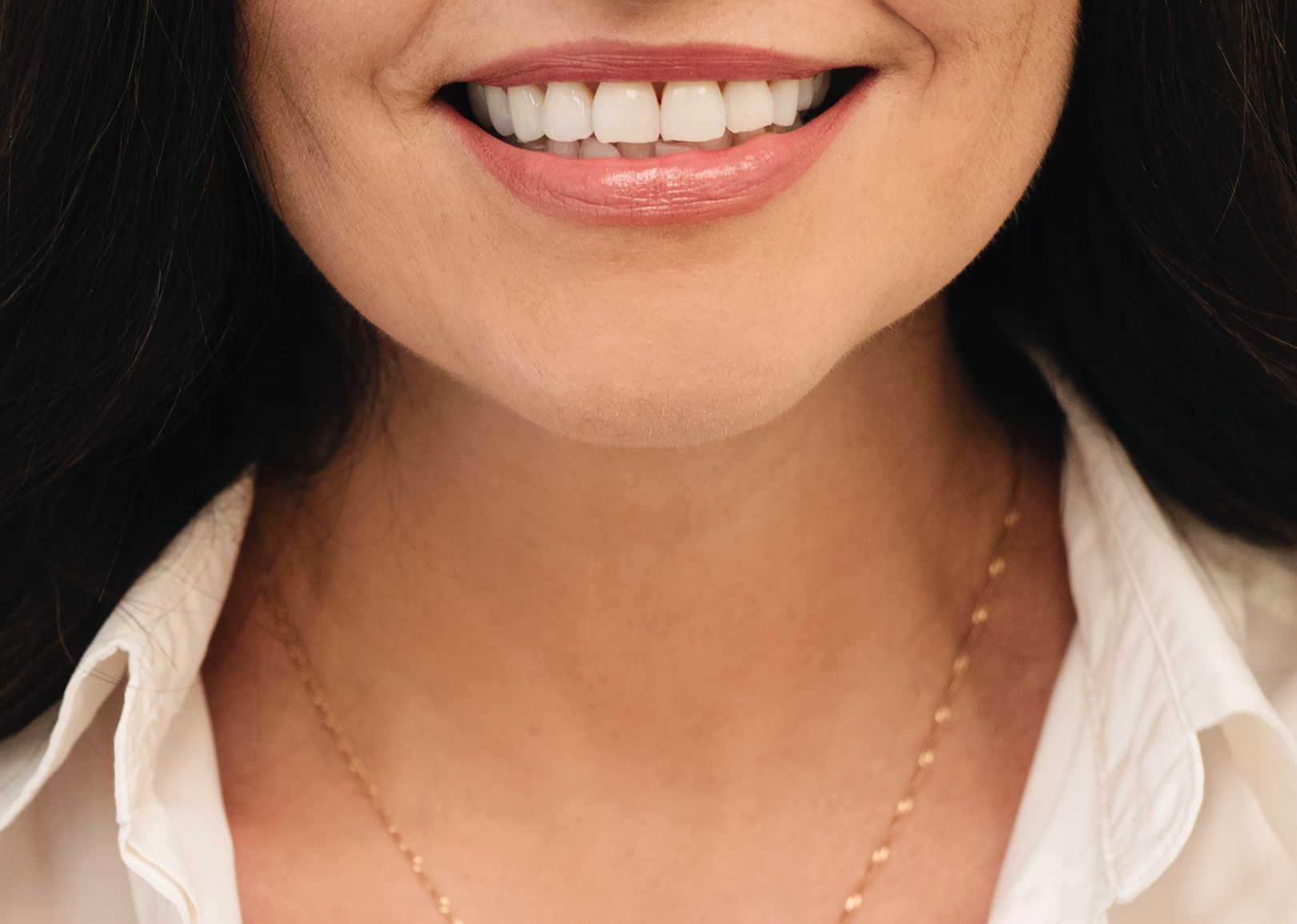 Kas yra dantų laminatės